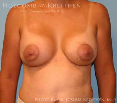 Breast Augmentation with Lift Before & After Gallery - Patient 6276487 - Image 2