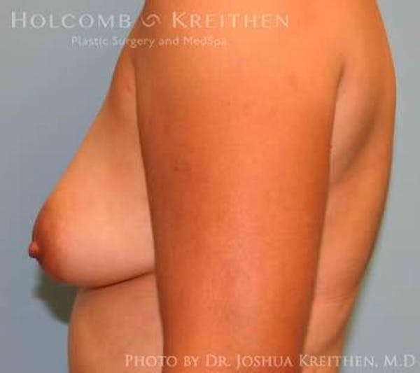 Breast Augmentation with Lift Before & After Gallery - Patient 6276487 - Image 5