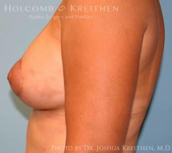 Breast Augmentation with Lift Gallery - Patient 6276487 - Image 6