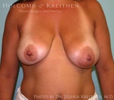 Breast Lift Before & After Gallery - Patient 6276537 - Image 1