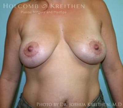 Breast Lift Before & After Gallery - Patient 6276537 - Image 2