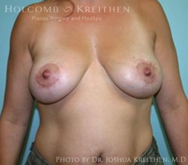 Breast Lift Before & After Gallery - Patient 6276537 - Image 2