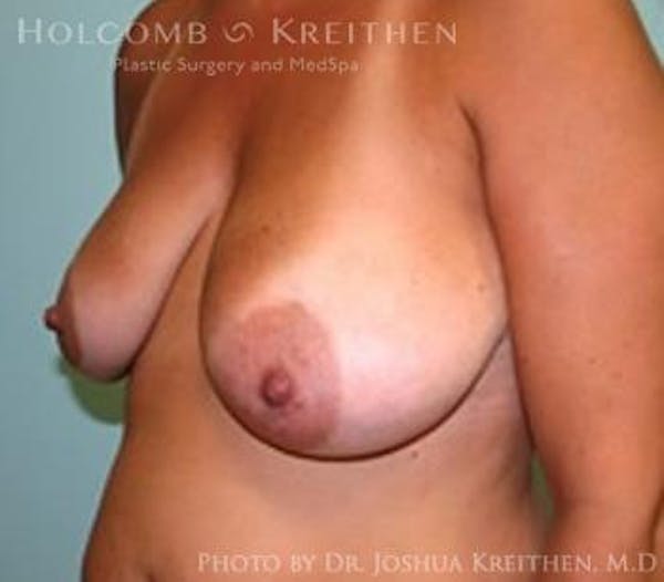 Breast Lift Gallery - Patient 6276537 - Image 3