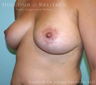 Breast Lift Before & After Gallery - Patient 6276537 - Image 4