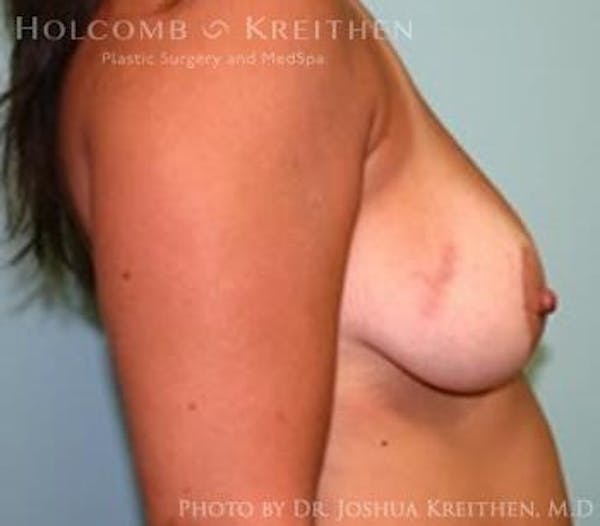 Breast Lift Before & After Gallery - Patient 6276537 - Image 5