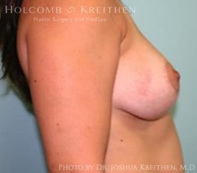 Breast Lift Before & After Gallery - Patient 6276537 - Image 6
