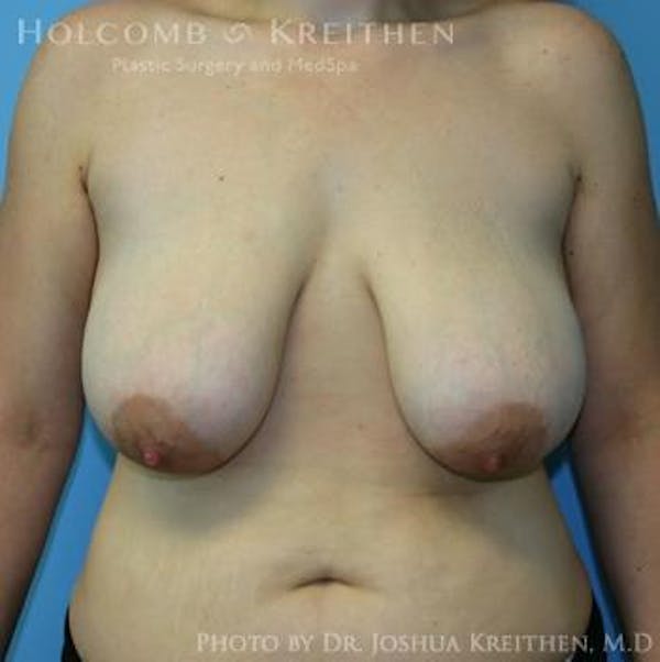 Breast Lift Before & After Gallery - Patient 6276540 - Image 1