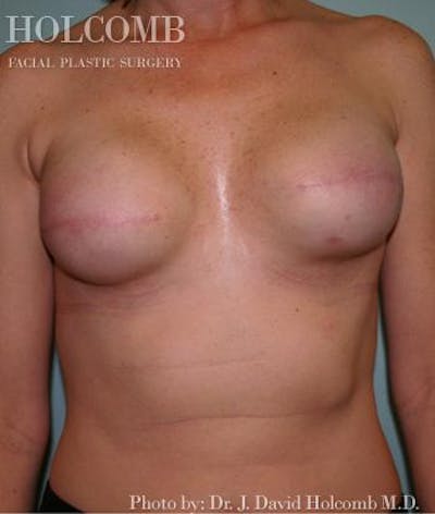 Breast Reconstruction Before & After Gallery - Patient 6276538 - Image 2