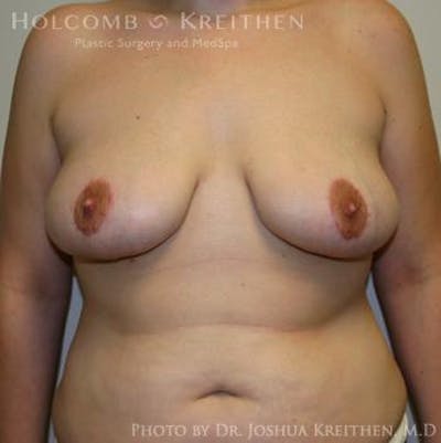 Breast Lift Before & After Gallery - Patient 6276540 - Image 2