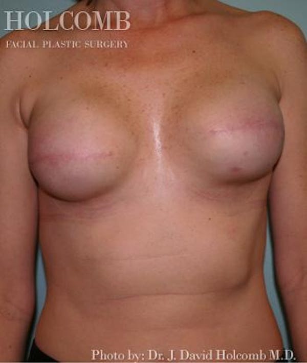 Breast Reconstruction Before & After Gallery - Patient 6276538 - Image 3