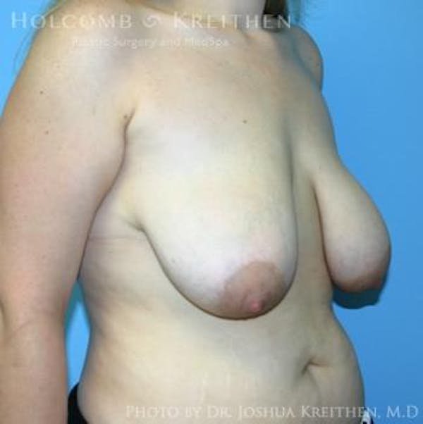 Breast Lift Before & After Gallery - Patient 6276540 - Image 3