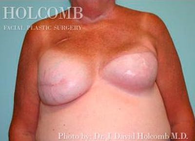 Breast Reconstruction Before & After Gallery - Patient 6276539 - Image 1