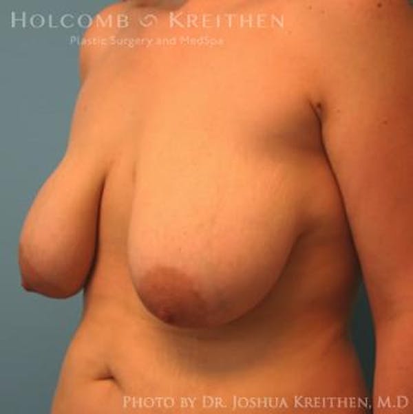 Breast Lift Before & After Gallery - Patient 6276540 - Image 5