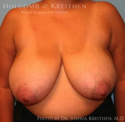Breast Reduction Before & After Gallery - Patient 6276542 - Image 1