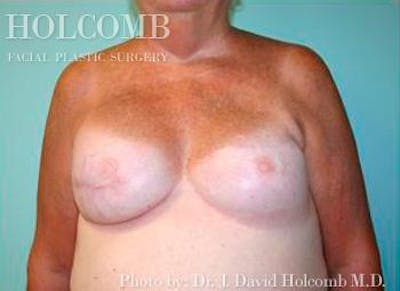 Breast Reconstruction Before & After Gallery - Patient 6276539 - Image 2