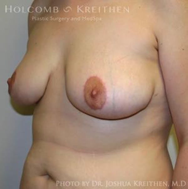 Breast Lift Before & After Gallery - Patient 6276540 - Image 6