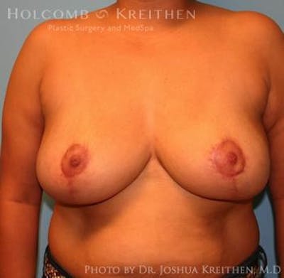 Breast Reduction Before & After Gallery - Patient 6276542 - Image 2