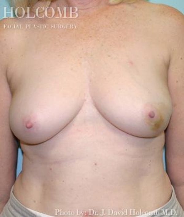 Breast Reconstruction Gallery - Patient 6276541 - Image 1