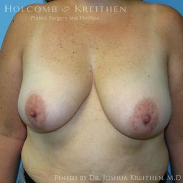 Breast Lift Before & After Gallery - Patient 6276545 - Image 1