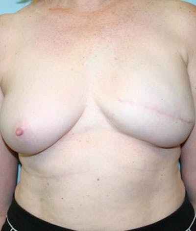 Breast Reconstruction Gallery - Patient 6276541 - Image 2