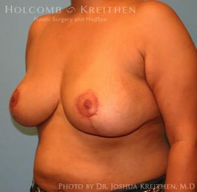 Breast Reduction Before & After Gallery - Patient 6276542 - Image 4