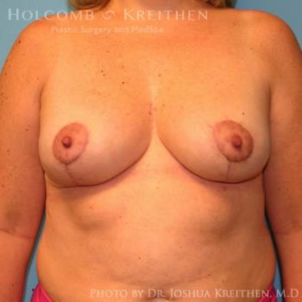 Breast Lift Before & After Gallery - Patient 6276545 - Image 2