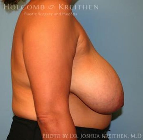 Breast Reduction Before & After Gallery - Patient 6276542 - Image 5