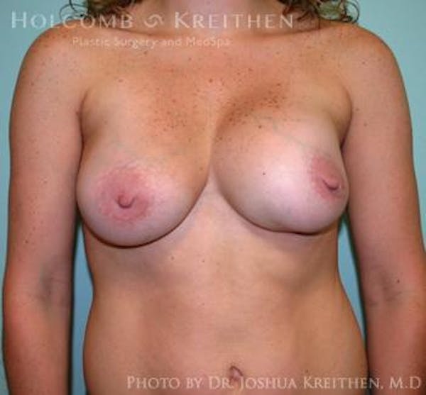 Breast Revision Before & After Gallery - Patient 6276543 - Image 1