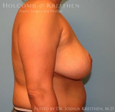 Breast Reduction Gallery - Patient 6276542 - Image 6