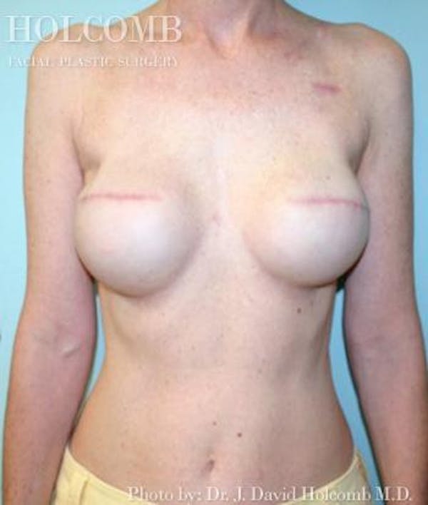 Breast Reconstruction Before & After Gallery - Patient 6276544 - Image 2