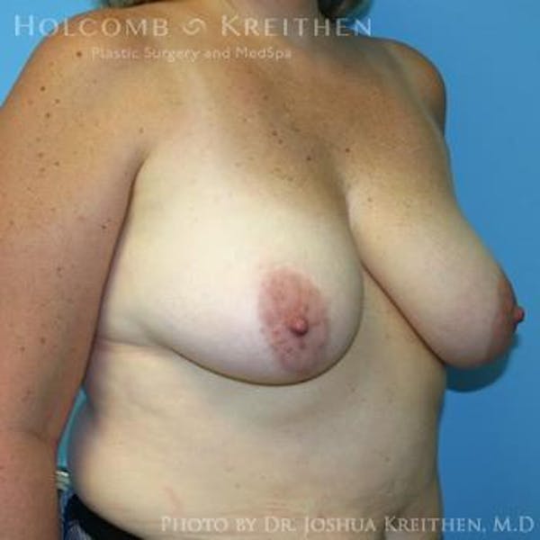 Breast Lift Before & After Gallery - Patient 6276545 - Image 5