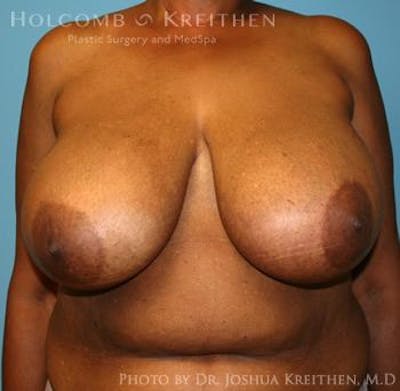 Breast Reduction Before & After Gallery - Patient 6276546 - Image 1