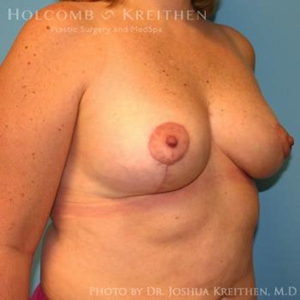 Breast Lift Before & After Gallery - Patient 6276545 - Image 6
