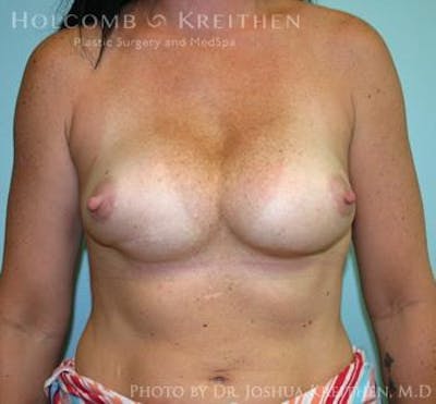 Breast Revision Before & After Gallery - Patient 6276553 - Image 1