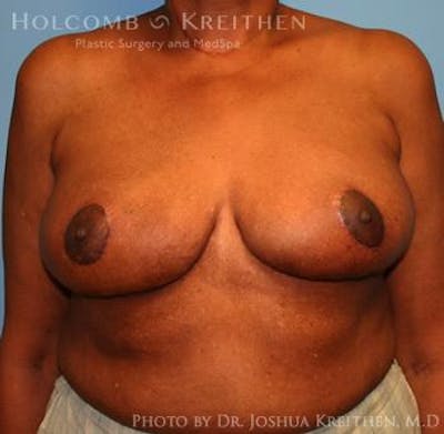 Breast Reduction Before & After Gallery - Patient 6276546 - Image 2