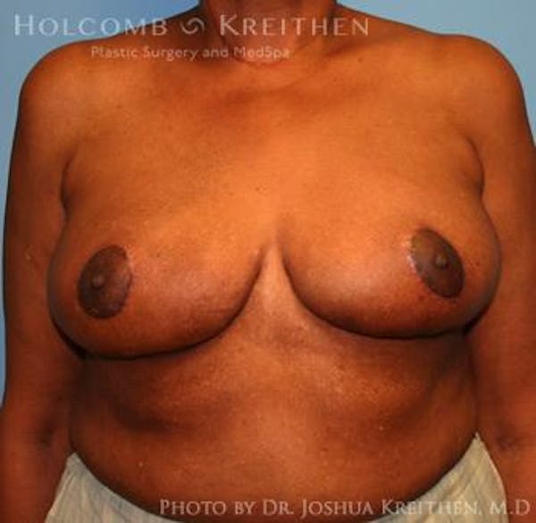 Breast Reduction Before & After Gallery - Patient 6276546 - Image 2
