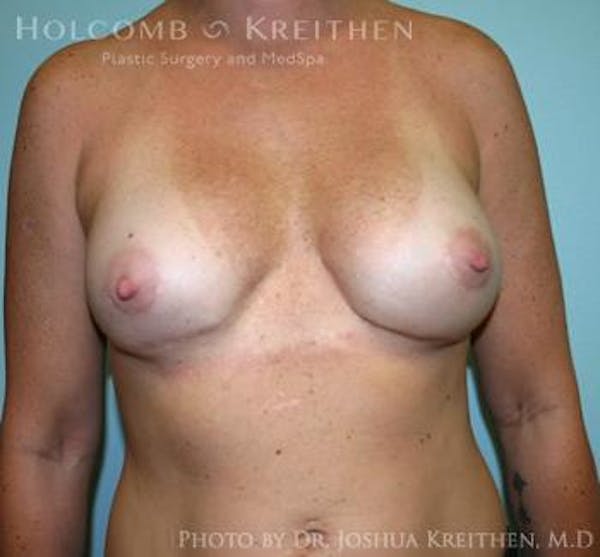 Breast Revision Before & After Gallery - Patient 6276553 - Image 2