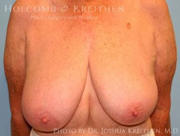 Breast Lift Before & After Gallery - Patient 6276562 - Image 1