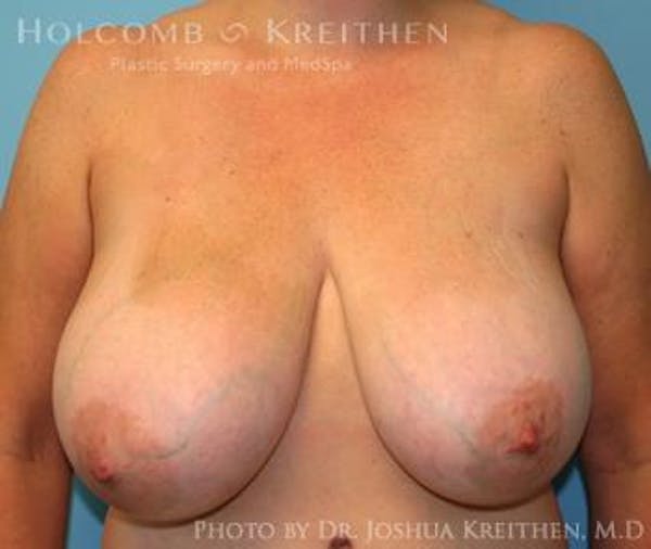 Breast Reduction Before & After Gallery - Patient 6276563 - Image 1