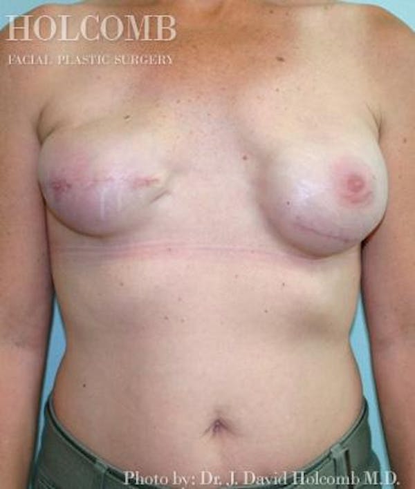 Breast Reconstruction Before & After Gallery - Patient 6276560 - Image 3