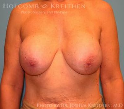 Breast Revision Before & After Gallery - Patient 6276564 - Image 1
