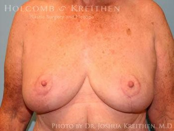 Breast Lift Gallery - Patient 6276562 - Image 2
