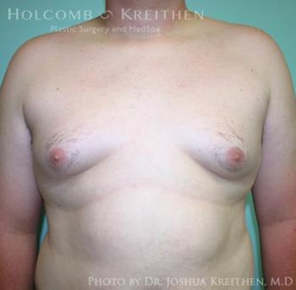 Gynecomastia Before & After Gallery - Patient 6276561 - Image 1