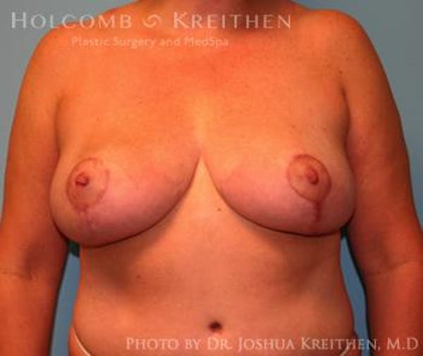 Breast Reduction Before & After Gallery - Patient 6276563 - Image 2