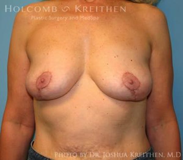 Breast Revision Before & After Gallery - Patient 6276564 - Image 2