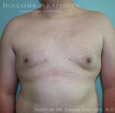 Gynecomastia Before & After Gallery - Patient 6276561 - Image 2