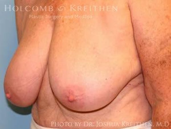 Breast Lift Before & After Gallery - Patient 6276562 - Image 3