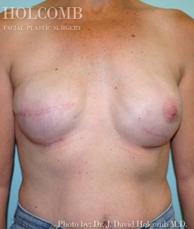 Breast Reconstruction Before & After Gallery - Patient 6276560 - Image 4