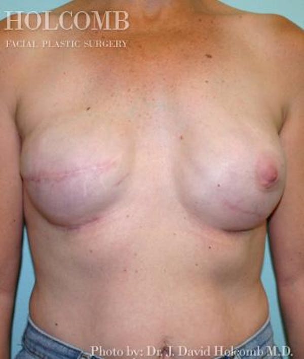 Breast Reconstruction Before & After Gallery - Patient 6276560 - Image 4