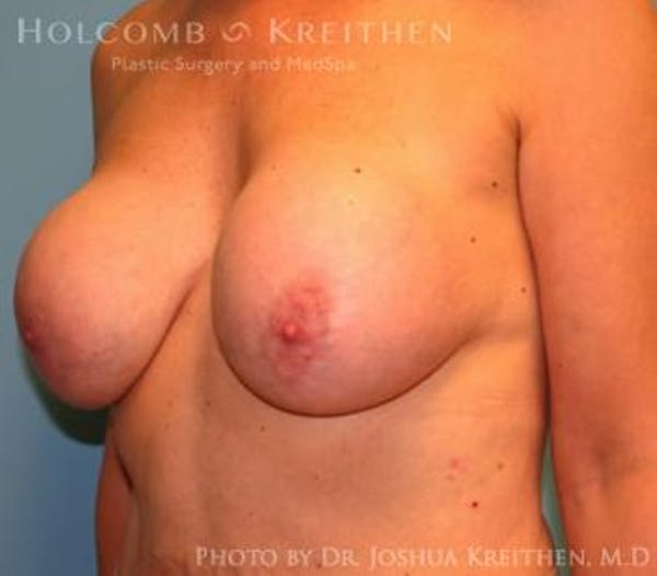 Breast Revision Gallery - Patient 6276564 - Image 3